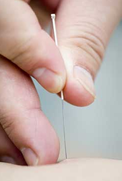 Acupuncture