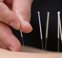 Acupuncture