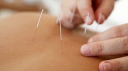 Acupuncture