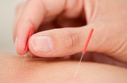 Acupuncture