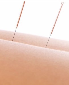 Acupuncture 0 Acupuncture