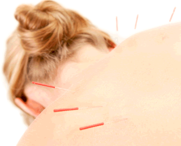 What is acupuncture?