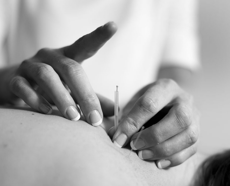 Acupuncture & Dry Needling