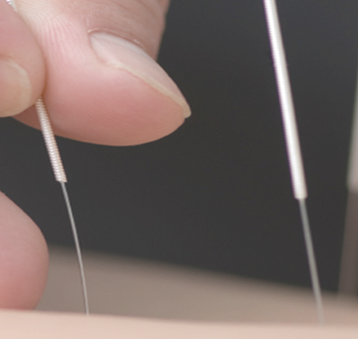 What is Acupuncture?