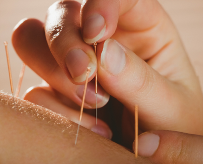 Acupuncture