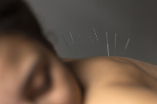 Acupuncture