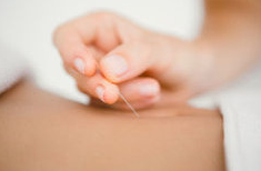 Acupuncture