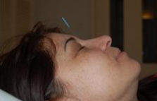 Acupuncture