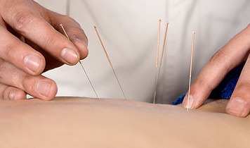 Acupuncture