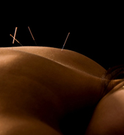 Traditional Chinese Acupuncture