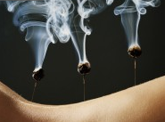 Moxibustion