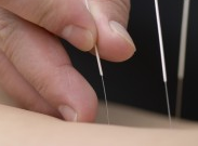 Acupuncture